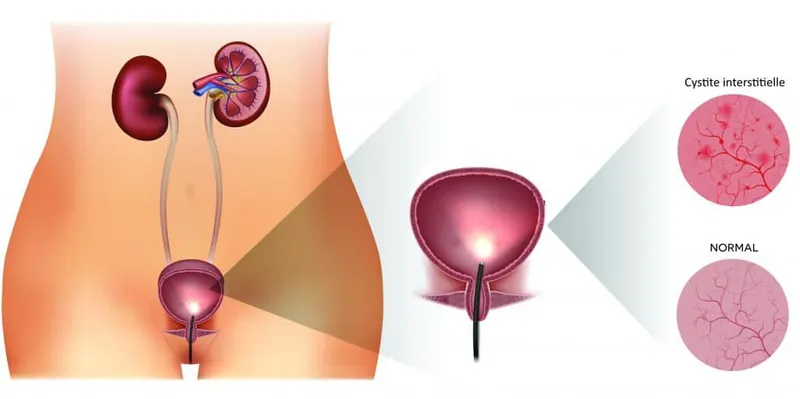 La cystite interstitielle ou le syndrome de la vessie douloureuse